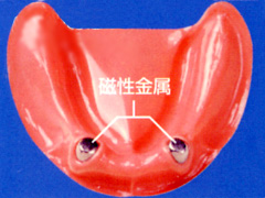マグネット式入れ歯の構造